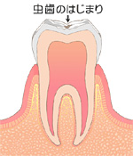 初期段階 ~削る必要はありません~