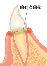 2.歯肉炎(しにくえん)