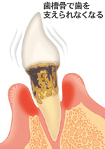 5.重度・歯周病(ししゅうえん)